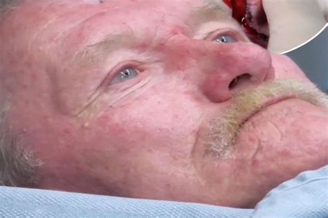 Watch Dr Pimple Popper Squeeze Mash Potato Style Pus From Mans