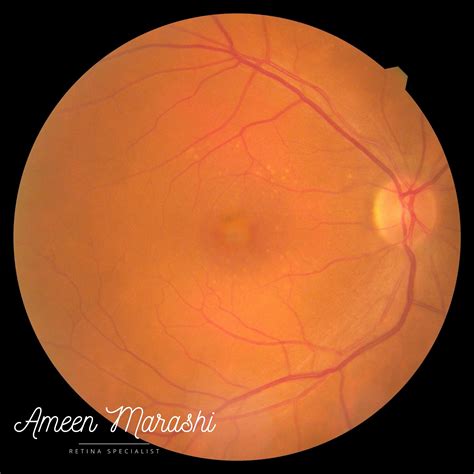 Adult Onset Vitelliform Macular Dystrophy