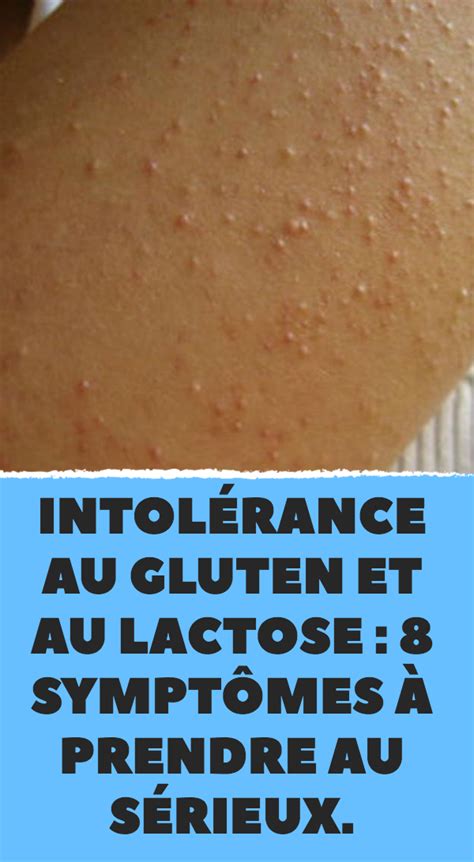 Intolérance au gluten et au lactose 8 symptômes à prendre au sérieux