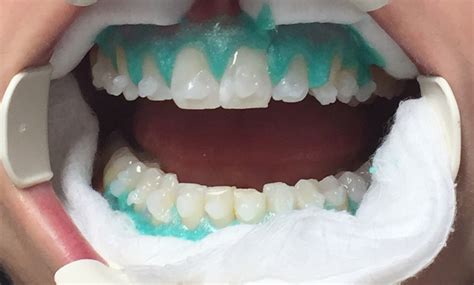 Laser Teeth Whitening For A Vibrant Smile Jindal Dental Care