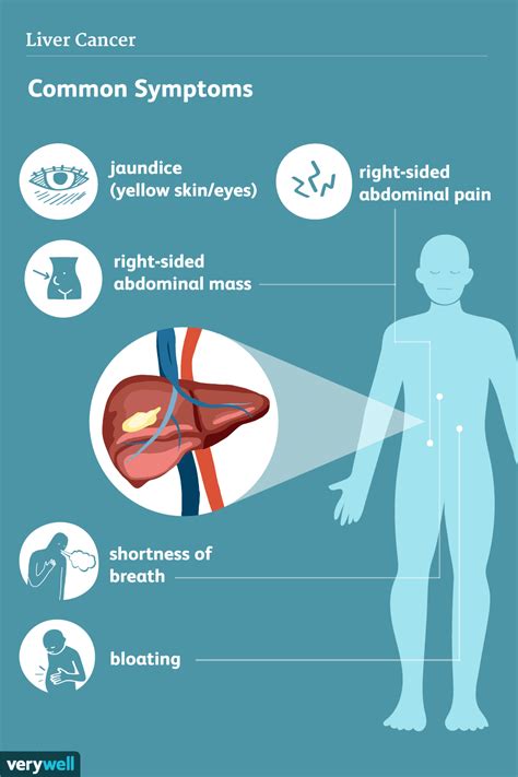 Symptoms Of Liver Cancer 2022