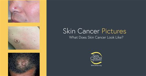 Skin Cancer Pictures The Skin Cancer Foundation