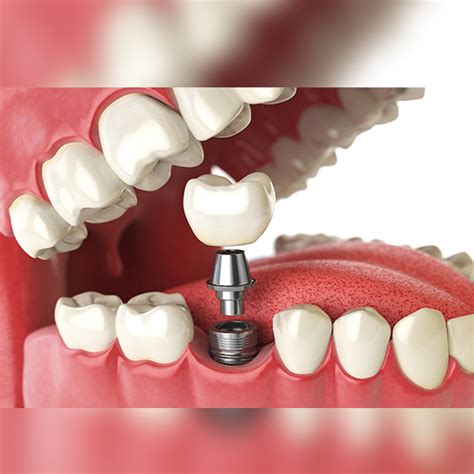 Prótese Sobre Implante Em Santos Valdo Prótese Dentária