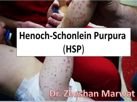Iga Vasculitis Guide Causes Symptoms Diagnosis Of Henoch Schonlein