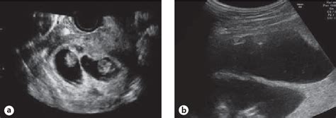 Figure 1 From Monochorionic Monozygotic Twin Pregnancy Complicated With
