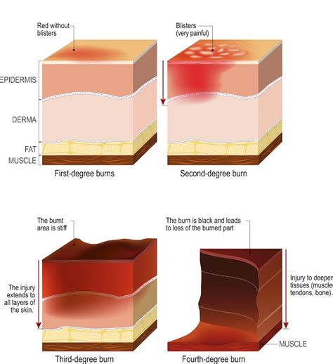 Common Injuries Burns Rainwater Holt And Sexton