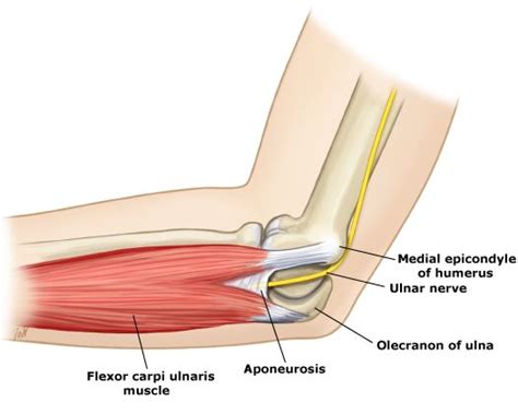 Cubital Tunnel Syndrome Presentation And Treatment Bone And Spine