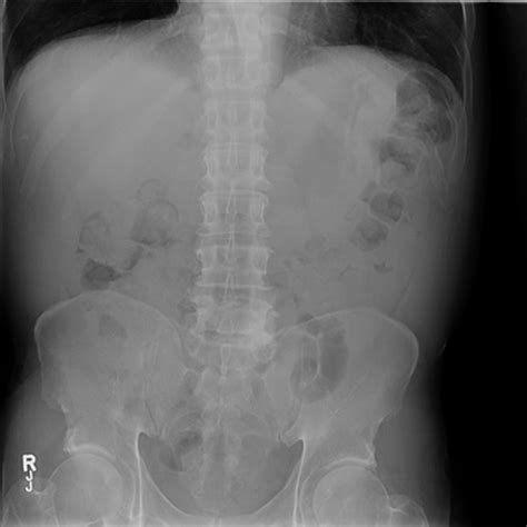 Incarcerated Amyands Hernia With Acute Appendicitis A Case Report