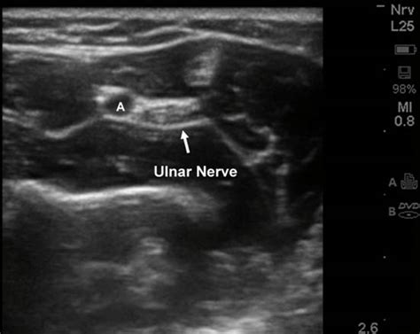 Ulnar Nerve Block Ultrasound