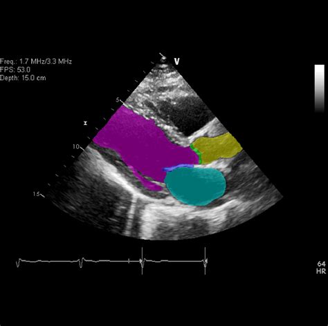 Cardiovascular Ultrasound Software For Real Time Appraisal