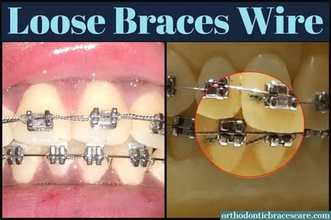 How To Fix Loose Wire On Braces Step By Step Guide Orthodontic Braces Care