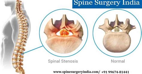 Pin On Spine Surgery In India