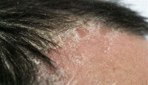 Red Spots On Scalp Pictures Causes And Treatments Vlrengbr