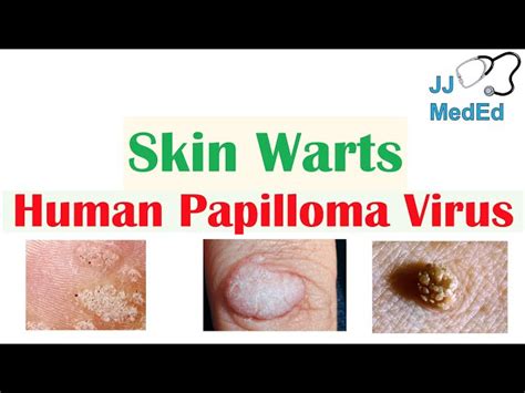 Viral Warts Symptoms