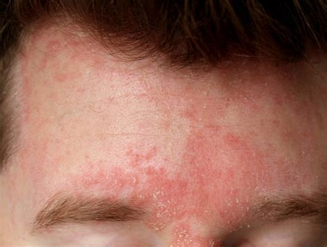 Bolezen kože seboroični dermatitis Zdravstveni nasvet