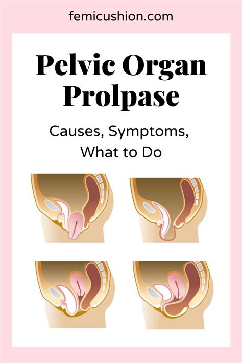 Different Types Of Pelvic Organ Prolapse Pelvic Organ Prolapse Uterine Prolapse Bladder Prolapse