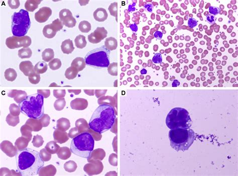 A Peripheral Blood Smear In 2012 Showed Scanty Atypical