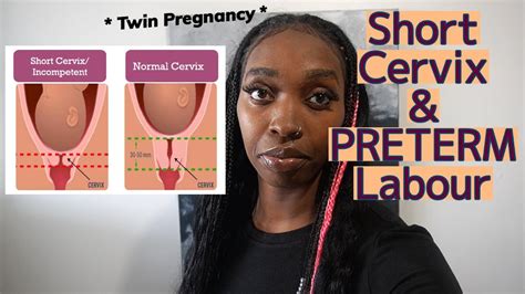 My Incompetent Cervix Story Short Cervix While 5 Months Pregnant With