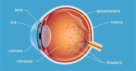 Eye Floaters Treatment And Causes All About Vision El Festival