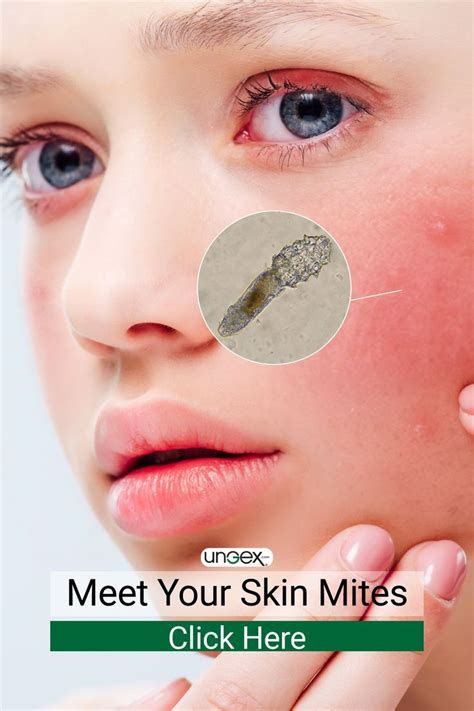 Demodex Mites Infestation Combat Your Skin Pests In Demodex