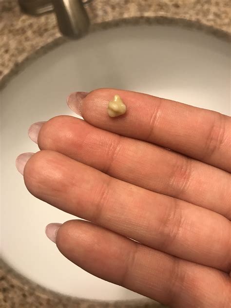 This Is By Far The Biggest Tonsil Stone Ive Ever Taken Out Rpopping