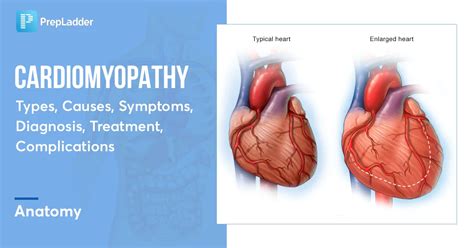 Cardiomyopathy Types Causes Symptoms Diagnosis Treatment