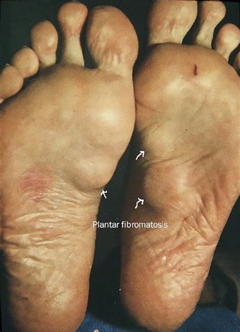 Tumors Of The Foot Causes And Treatment Options