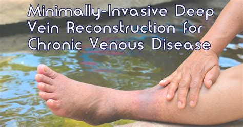 Minimally Invasive Deep Vein Reconstruction For Chronic Venous Disease
