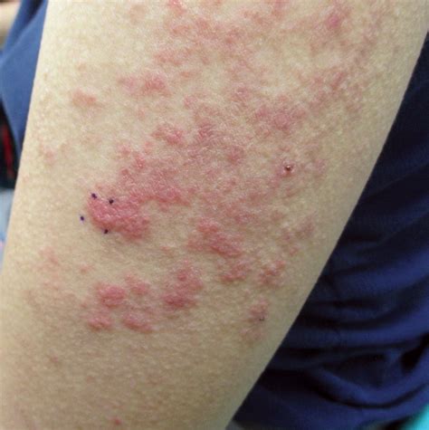 Lupus Rash On Arms And Hands
