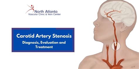 Carotid Artery Stenosis Diagnosis Evaluation And Treatment