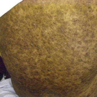 Hidradenitis suppurativa isn't treated really. Pin on HS