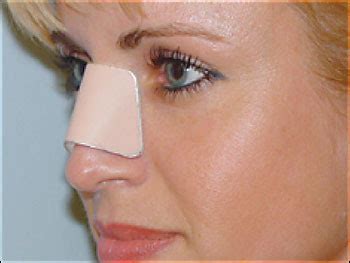 Post Rhinoplasty Discomforts - Deviated Septum Information ...