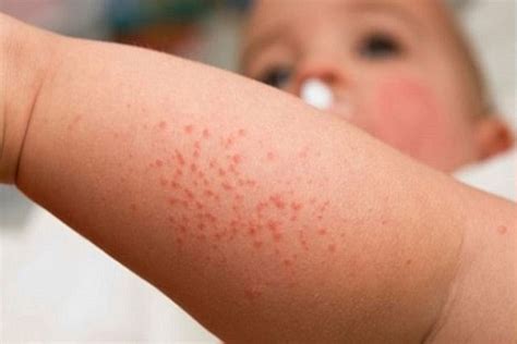 13 Causes Of Non Itchy Rash