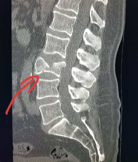What Does A Ct Scan Of Spine Show Ct Scan Machine