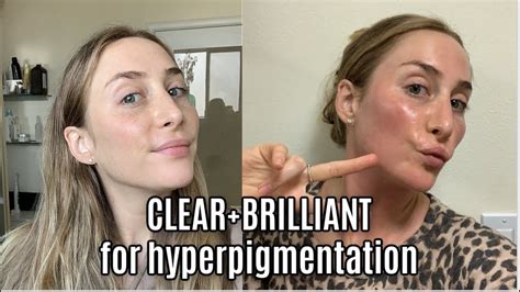 My Clear Brilliant Laser Review With Before Afters Youtube