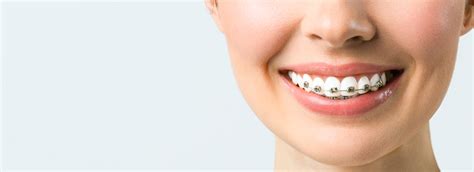 Best Orthodontist Houston Texas Affordable Orthodontics Services