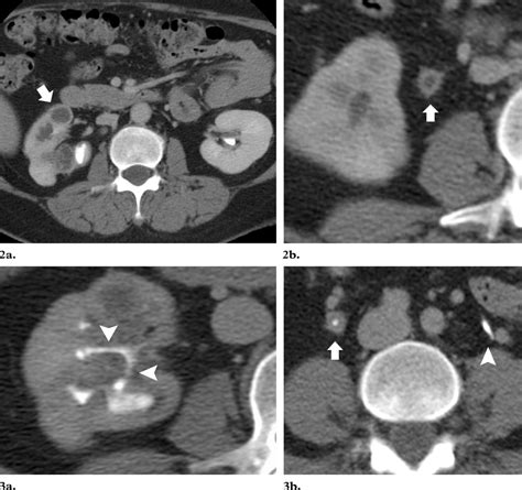 3 2a Contrast Enhanced Nephrographic Phase Ct Scan Shows Dilated