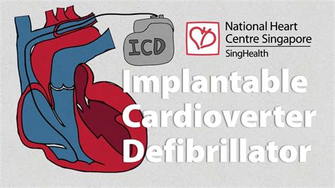 Implantable Cardioverter Defibrillator Icd Youtube