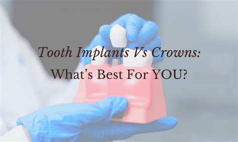 Tooth Implants Vs Crowns Your Best Choice The Smile Clinic