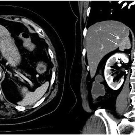 Contrast Enhanced Computed Tomography Findings At The Time Of