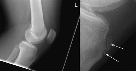 Osgood Schlatter Disease Radiology At St Vincents University Hospital