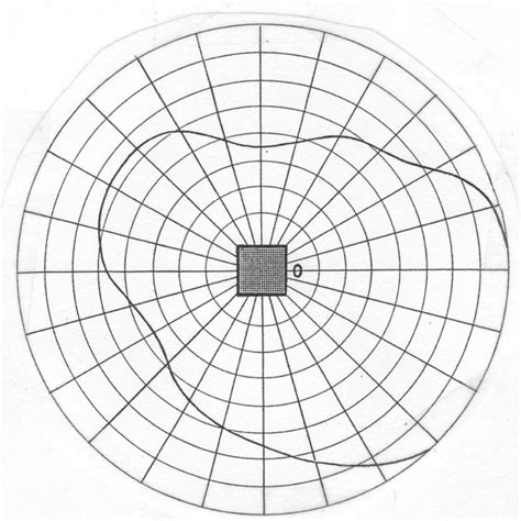 The Amsler Grid Within The Visual Field Drawing Photocopied With