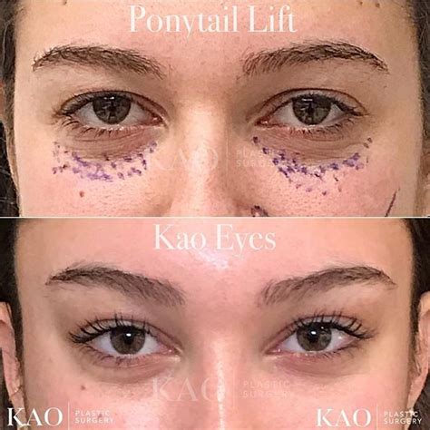 49 Best Pictures Cat Eye Surgery Before And After Cat Eye Cosmetic