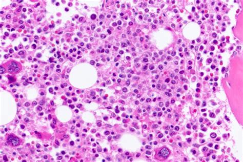 These cells malfunction and, over time, die. ¿Ayuda del aceite de cannabis a la enfermedad de Niemann ...