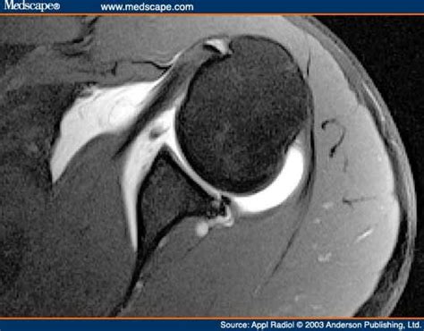 Paralabral Cyst Associated With Posterior Labral Tear