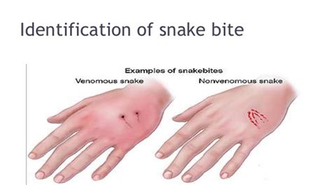 Snake Bites Blind Spot In Health Delivery The Manicapost