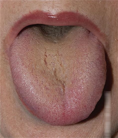Scielo Brasil Black Coated Tongue In Integrative Medicine An Alarm