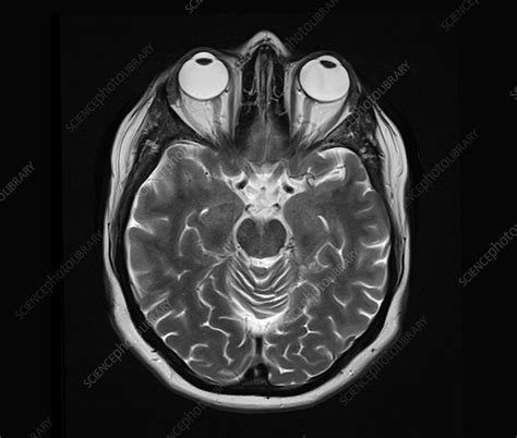 Human Eyes And Brain Mri Scan Stock Image C0337456 Science Photo