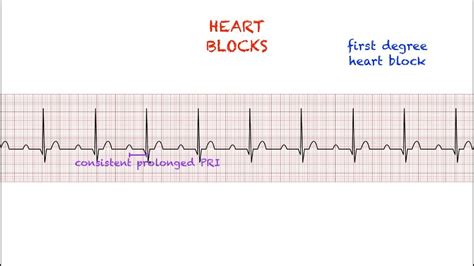 Heart Blocks Interpretation Easy And Simple Youtube
