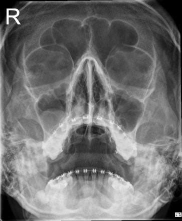 Mucous Retention Cysts Of Maxillary Sinus Radiology Case